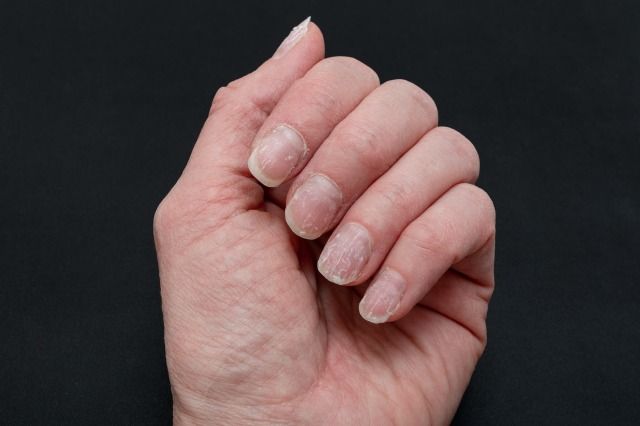 ボロボロに薄くなった爪