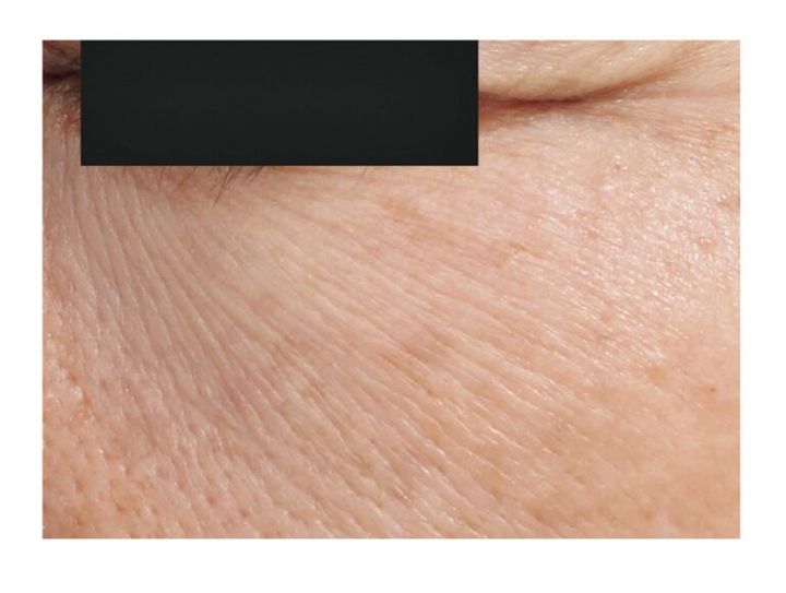 全顔の散在シワの例