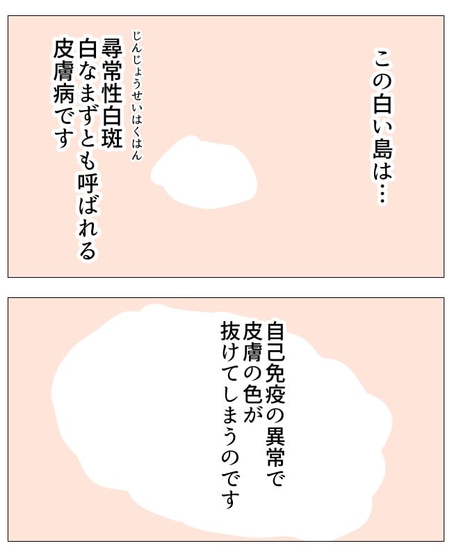 娘の尋常性白斑／フワリー