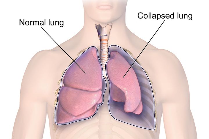 胸壁内に空気がたまり、肺を圧迫する