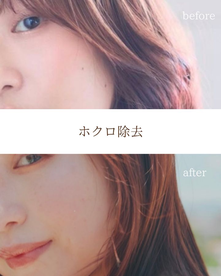 ホクロ除去