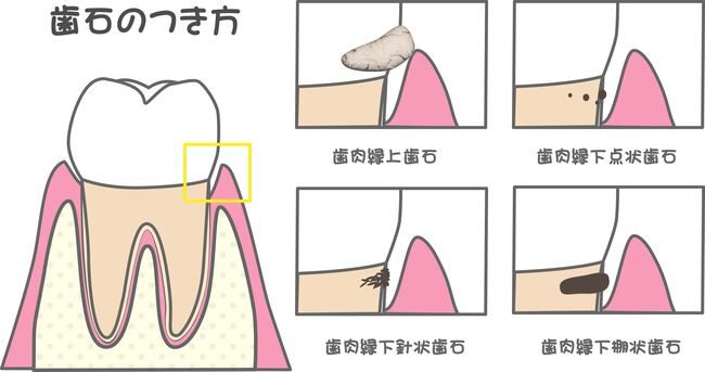 認知症リスクを下げるカギは「歯磨き！？」歯科医が教える正しいオーラルケアの方法【医師解説】
