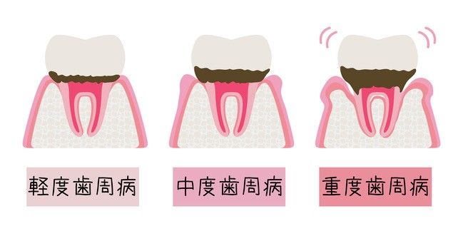 認知症リスクを下げるカギは「歯磨き！？」歯科医が教える正しいオーラルケアの方法【医師解説】