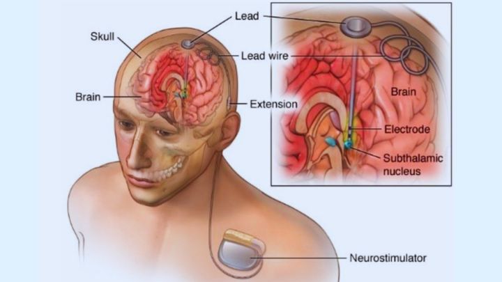 「もう治らない」と諦めた慢性痛、脳に埋め込む電極が救った