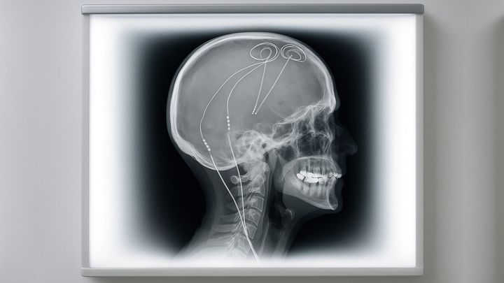 脳電極で「慢性的な痛み」を救う方法が開発された
