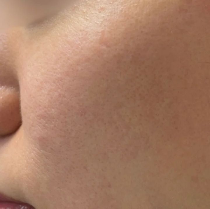 毛穴 美容医療 プルリアル アフター