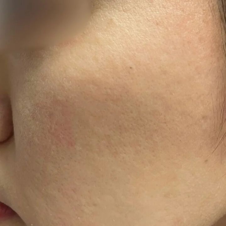 毛穴 美容医療 プルリアル ビフォー