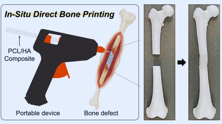 骨折したら「生分解性人工骨」をその場でプリントできる新技術が開発