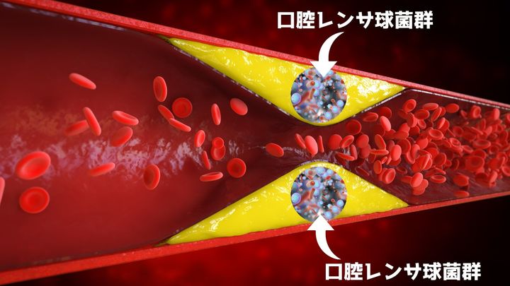心筋梗塞の原因となるプラーク中に「口の細菌」が含まれていた
