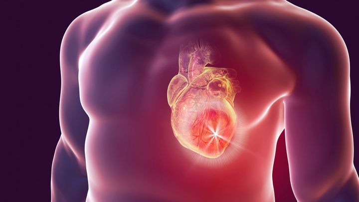 ウイルス感染などのキッカケから心臓発作が起こる仕組み