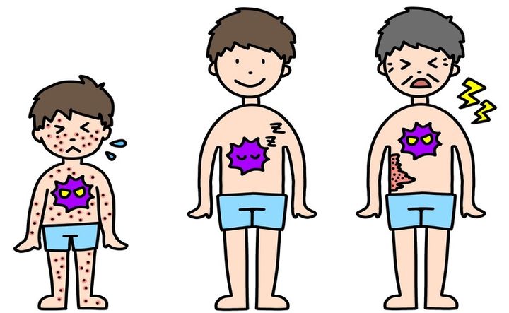 50代からは皮膚感染症に注意！「帯状疱疹」や「水虫」はうつる？家庭内で予防するポイントは【医師解説】