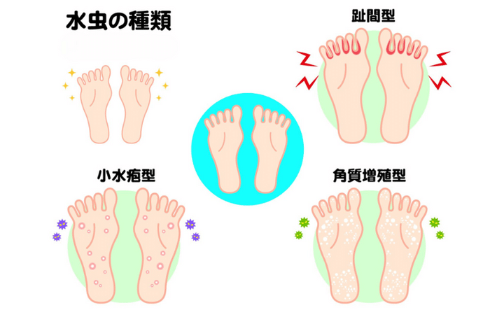 50代からは皮膚感染症に注意！「帯状疱疹」や「水虫」はうつる？家庭内で予防するポイントは【医師解説】