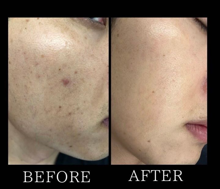 ABCメソッドで肌が変わった！