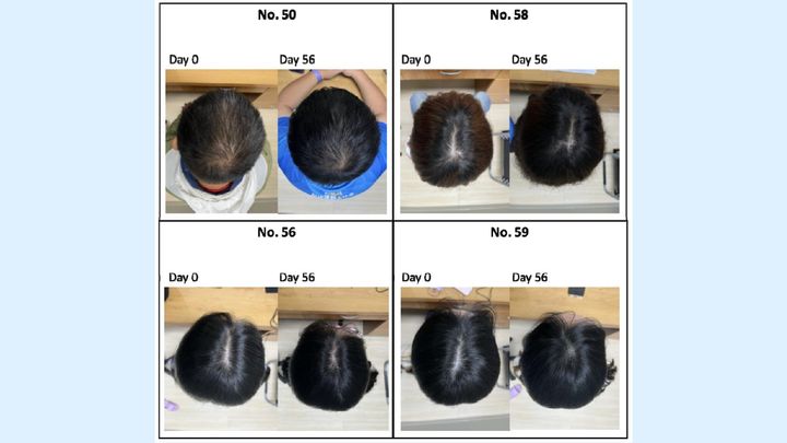 ０日目と５６日目の髪の比較。見た目でも大きく増えていることがわかります