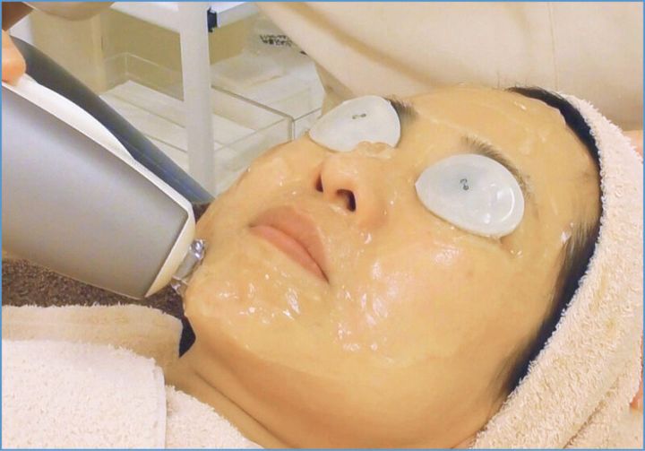 メスのいらないシワ取り治療でリフトアップも！サブライム