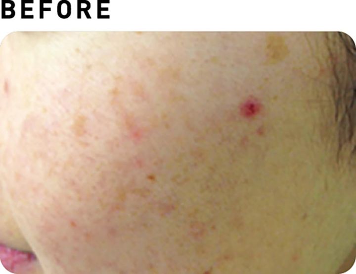 フォトフェイシャルStellar M22【BEFORE】