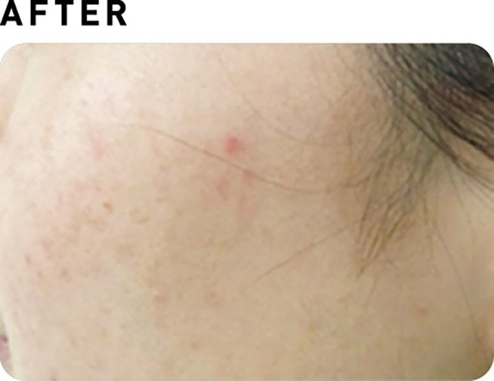 フォトフェイシャルStellar M22【AFTER】