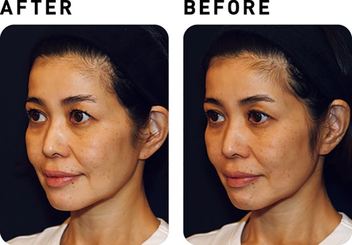 かがやき隊 高本有里子さんが美容医療 タイタンにトライ！【BEFORE&AFTER】