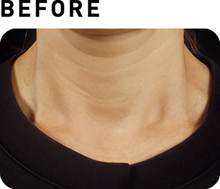 ソフウェーブ【BEFORE】