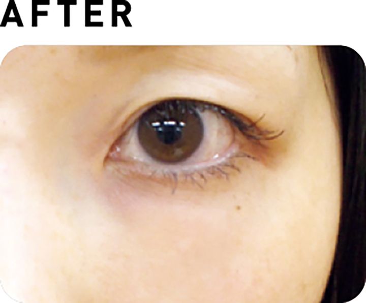 サーマクールアイ【AFTER】