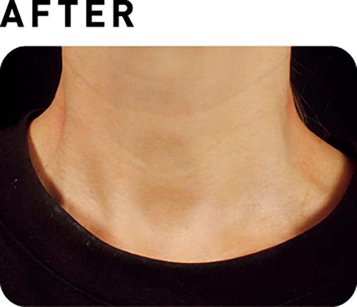 ソフウェーブ【AFTER】