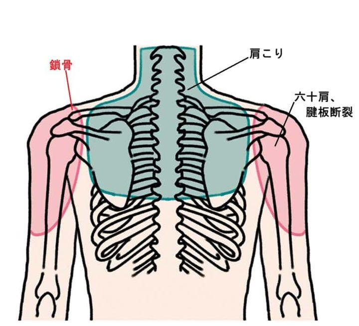 ３つの不調の痛みが出る場所の違い