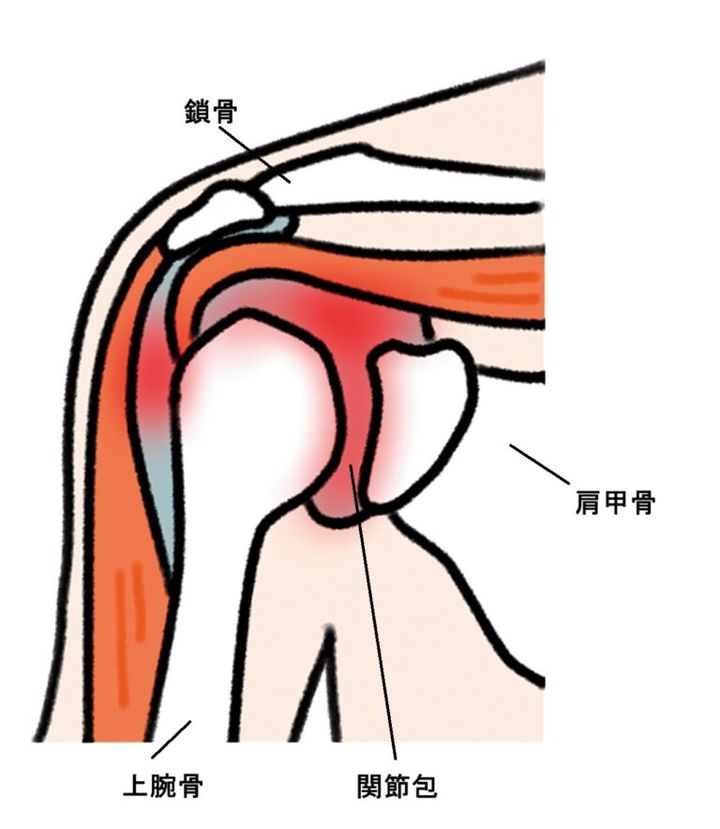 癒着性肩関節包炎