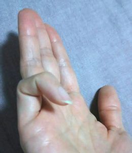 毎朝、小指が折り畳まれた状態に「脳に異常かも！？」恐怖の私に医師が告げた病気とは