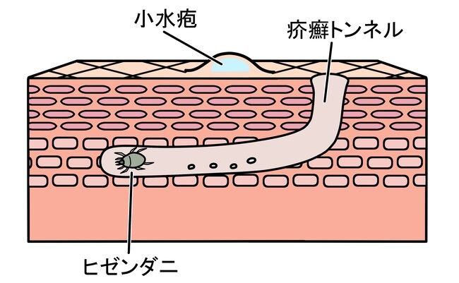 皮膚感染症「疥癬」のリスク