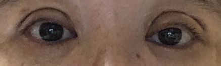 手術後の目の状態1