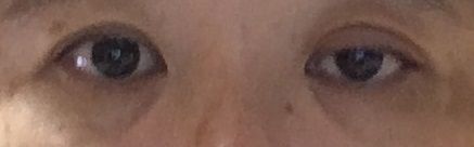 眼瞼下垂の状態