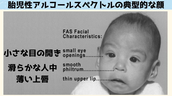 胎児性アルコールスペクトル障害の赤ちゃんの典型的な顔