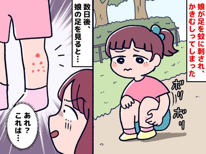 画像: ＜秋なのに、蚊！？＞公園で、幼い娘が蚊に刺されてしまった。翌朝 → 病院で『まさかの診断』が！