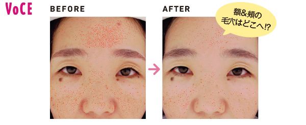 額＆頰の毛穴はどこへ⁉