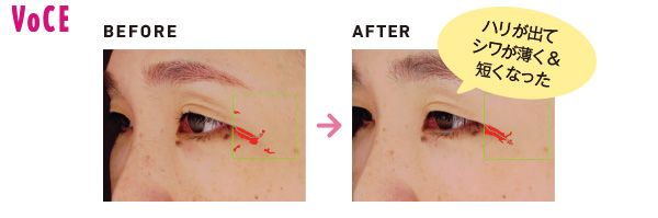 ハリが出てシワが薄く＆短くなった