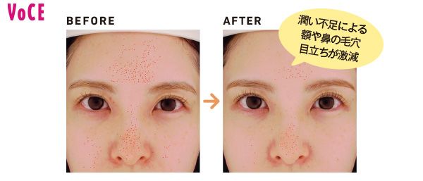 潤い不足による額や鼻の毛穴目立ちが激減