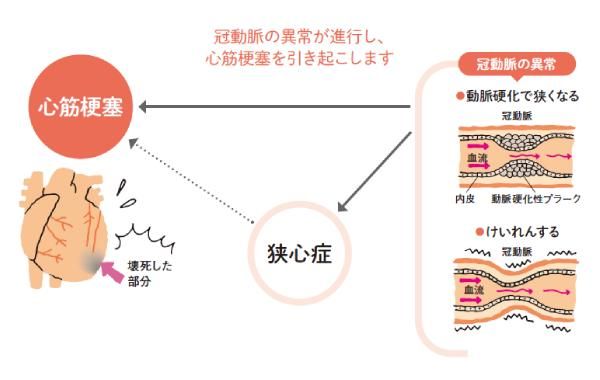 「心筋梗塞」ってどんな病気？注意したい症状は？_1