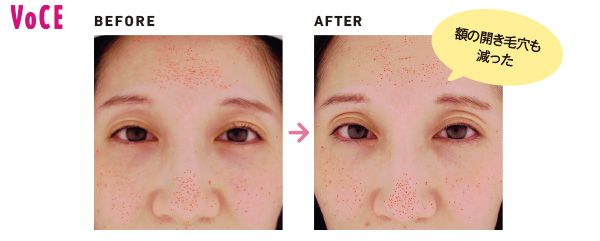 額の開き毛穴も減った