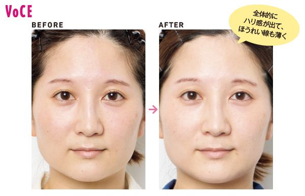 全体的にハリ感が出て、ほうれい線も薄く