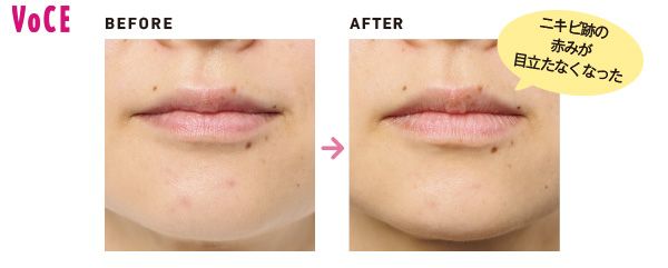 ニキビ跡の赤みが目立たなくなった