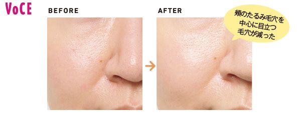 頰のたるみ毛穴を中心に目立つ毛穴が減った