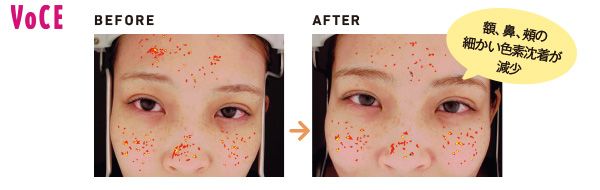 額、鼻、頰の細かい色素沈着が減少
