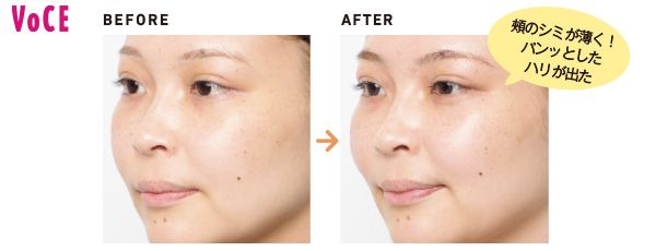 頰のシミが薄く！ パンッとしたハリが出た