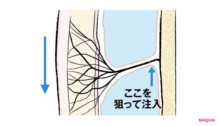 最新美容医療 ヒアルロン酸注入 リガメントを支えて補強する ビフォー