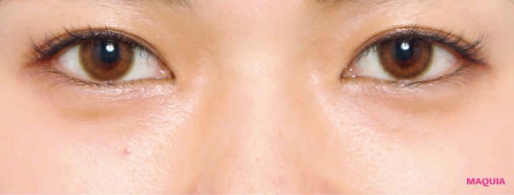 茶くまにおすすめの美容医療の治療スキンリファインピーリング アフター 3か月後