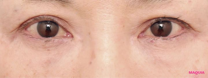 茶くまにおすすめの美容医療の治療 ヒアルロン酸注入 アフター 3か月後