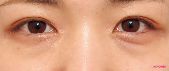 紫くまにおすすめの美容医療の治療 ベビーコラーゲン注射 ビフォー