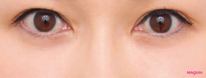 たるみくまにおすすめの美容医療の治療 下眼瞼脱脂術（結膜側） 下眼瞼脂肪注入 アフター 3か月後