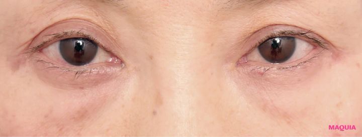 茶くまにおすすめの美容医療の治療 ヒアルロン酸注入 ビフォー