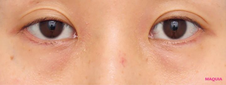 茶くまにおすすめの美容医療の治療 ハムラ法 ビフォー